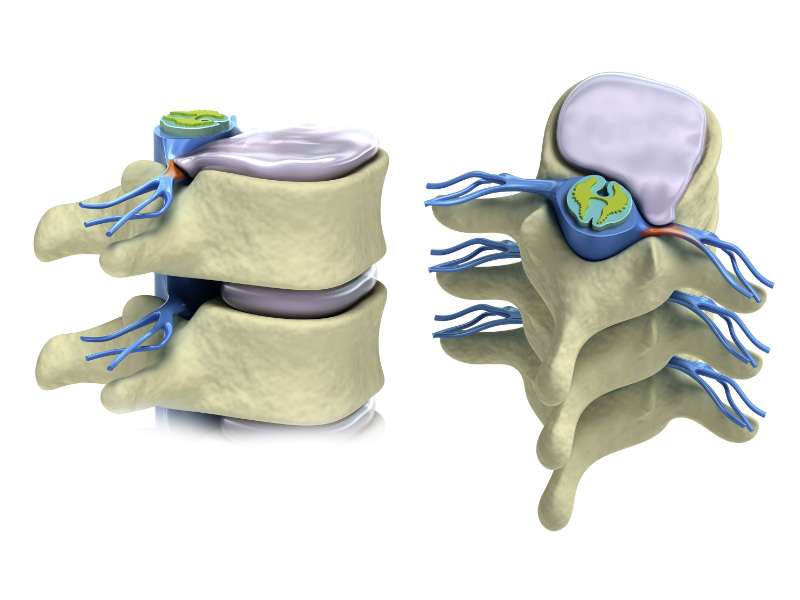 herniated disc image